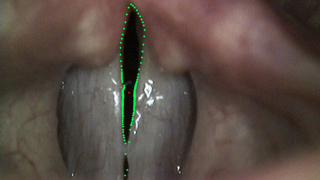Algorithms of computer analysis of laryngovideostroboscopic images of the larynx
