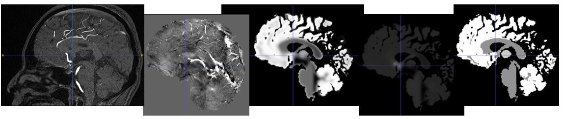 Fig. 2. MR images of the brain, from left: TOF, SWI, fractional blood volume, mean vessel density, mean vessel radius.